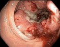 /album/fotogaleria/cancercolon-jpg/
