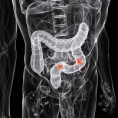 /album/fotogaleria/cancer-de-colon-jpg/