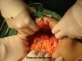 /album/fotogaleria/cancer-de-colon-derecho-jpg/